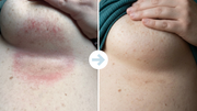 Underboob rash felt calmer fast