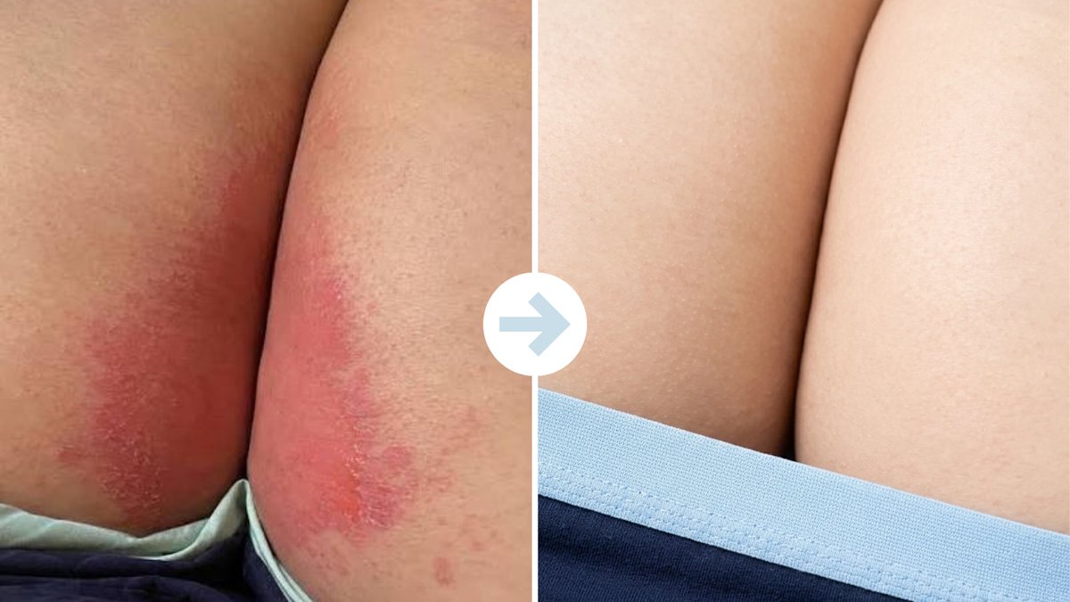 Thigh rash stopped stealing my walks